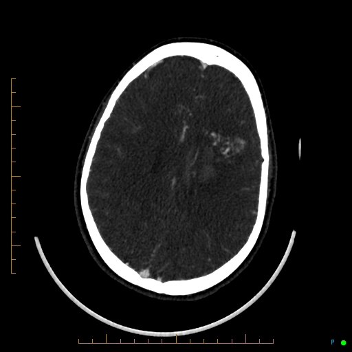 Cerebral arteriovenous malformation (AVM) (Radiopaedia 78162-90706 Axial CTA 187).jpg