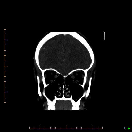 Cerebral arteriovenous malformation (AVM) (Radiopaedia 78162-90706 Coronal CTA 79).jpg
