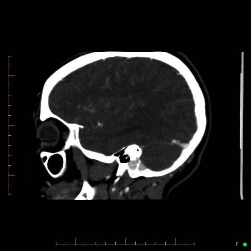 File:Cerebral arteriovenous malformation (AVM) (Radiopaedia 78162-90706 Sagittal CTA 59).jpg