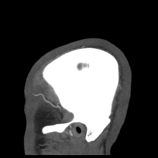 Cerebral arteriovenous malformation (Radiopaedia 39259-41505 Sagittal 57).png