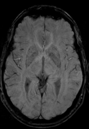File:Cerebral arteriovenous malformation (Radiopaedia 55798-62372 Axial SWI 19).png