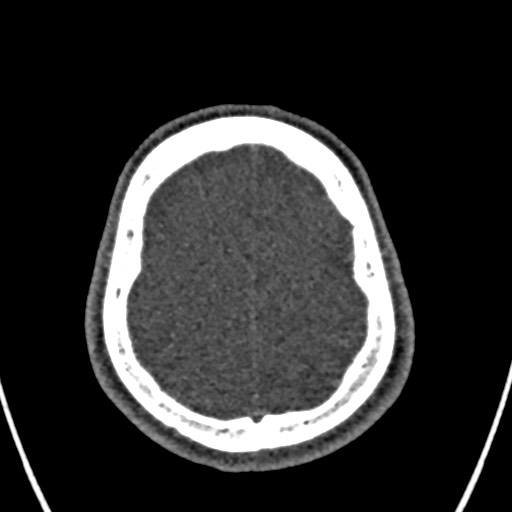 Cerebral arteriovenous malformation (Radiopaedia 78188-90746 Axial non-contrast 152).jpg