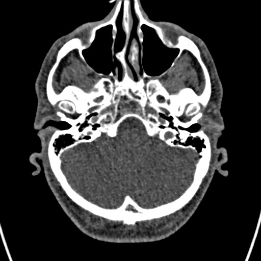 Cerebral arteriovenous malformation (Radiopaedia 78188-90746 Axial non-contrast 35).jpg