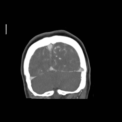 File:Cerebral arteriovenous malformation (Radiopaedia 79677-92888 B 43).jpg