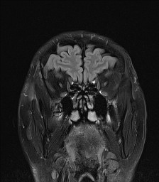 File:Cerebral arteriovenous malformation (Radiopaedia 84015-99245 Coronal FLAIR 7).jpg