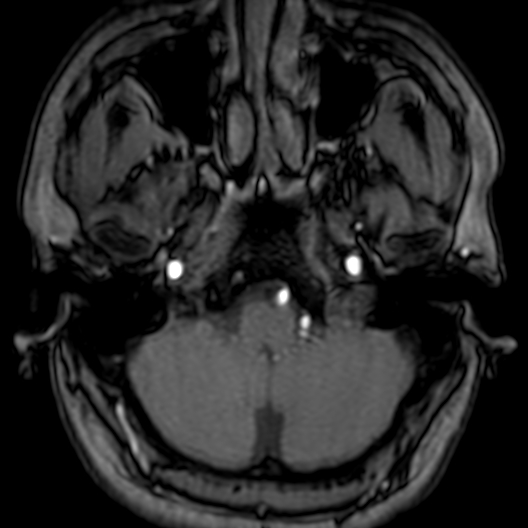 Cerebral arteriovenous malformation at posterior body of corpus callosum (Radiopaedia 74111-84925 Axial MRA 21).jpg