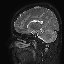 Cerebral arteriovenous malformation at posterior body of corpus callosum (Radiopaedia 74111-84925 Sagittal T2 80).jpg