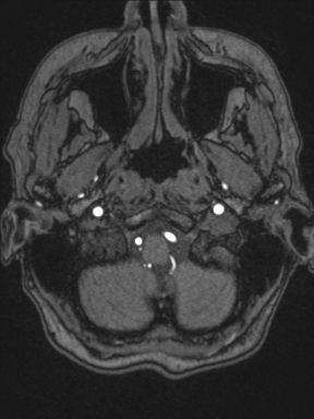 Cerebral arteriovenous malformation with hemorrhage (Radiopaedia 34422-35737 Axial MRA 6).png
