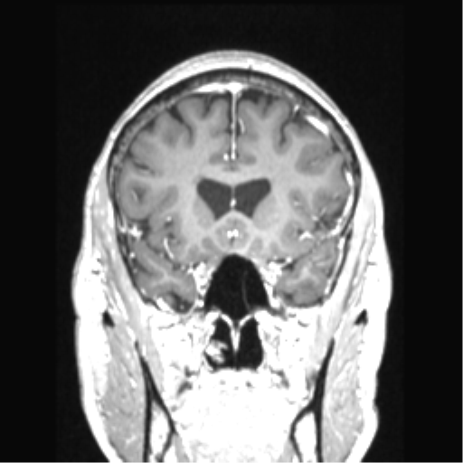 Cerebral arteriovenous malformation with hemorrhage (Radiopaedia 34422-35737 Coronal T1 C+ 63).png