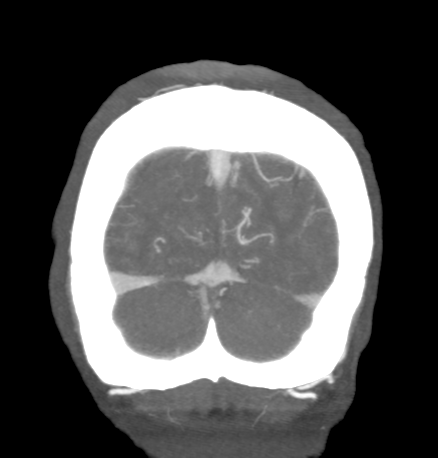 File:Cerebral arteriovenous malformation with lobar hemorrhage (Radiopaedia 44725-48511 B 51).png