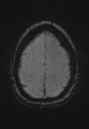 File:Cerebral cavernoma and development venous anomaly (Radiopaedia 37603-39482 Axial SWI 34).png
