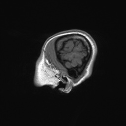 File:Cerebral cavernous venous malformation (Radiopaedia 70008-80021 Sagittal T1 5).jpg
