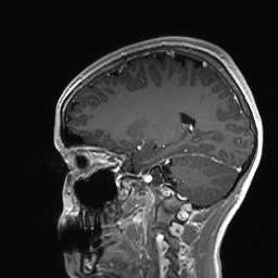 Cerebral cavernous venous malformation (Radiopaedia 70008-80021 Sagittal T1 C+ 26).jpg
