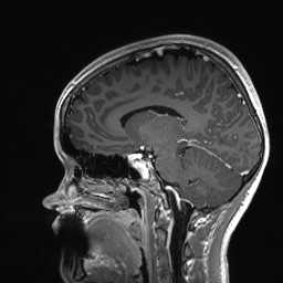 Cerebral cavernous venous malformation (Radiopaedia 70008-80021 Sagittal T1 C+ 31).jpg