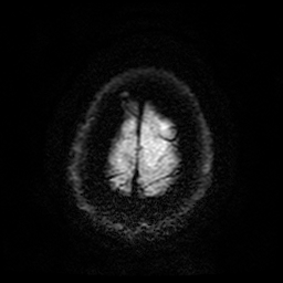File:Cerebral cavernous venous malformation (Zabramski type II) (Radiopaedia 85511-101198 Axial DWI 29).jpg