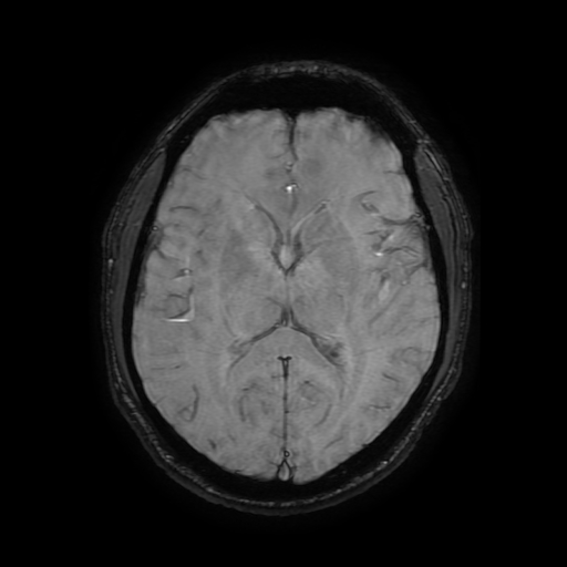 File:Cerebral cavernous venous malformation (Zabramski type II) (Radiopaedia 85511-101198 Axial SWI 69).jpg