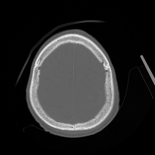 Cerebral contusions, subarachnoid hemorrhage and subdural hygromas (Radiopaedia 55399-61827 Axial bone window 43).png