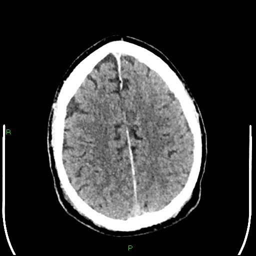 Cerebral contusions (Radiopaedia 33868-35039 Axial non-contrast 159).jpg