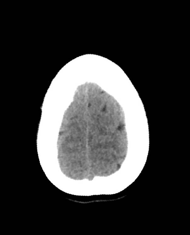 Cerebral edema due to severe hyponatremia (Radiopaedia 89826-106938 Axial non-contrast 90).jpg