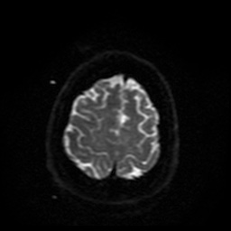 Cerebral embolic infarcts (embolic shower) (Radiopaedia 49837-55108 Axial DWI 7).jpg