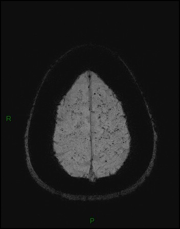 Cerebral fat embolism (Radiopaedia 35022-36525 Axial SWI 56).jpg