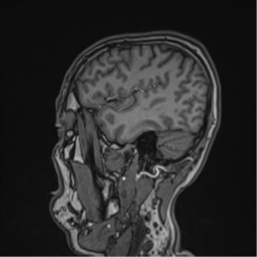 Cerebral fat embolism (Radiopaedia 57697-64639 Sagittal T1 38).png