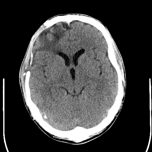 File:Cerebral hemorrhagic contusions- temporal evolution (Radiopaedia 40224-42756 Axial non-contrast 11).png