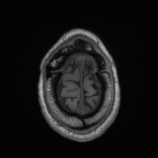 File:Cerebral hemorrhagic contusions- temporal evolution (Radiopaedia 40224-42757 Axial T1 71).png