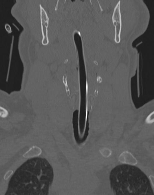 Cerebral hemorrhagic contusions and cervical spine fractures (Radiopaedia 32865-33841 Coronal bone window 7).jpg