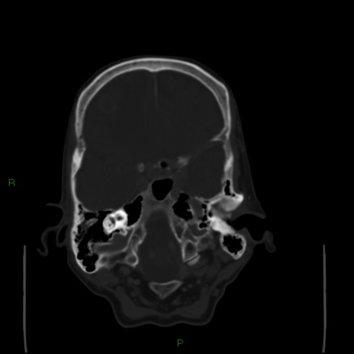 Cerebral metastases - breast primary (Radiopaedia 77653-89857 Axial bone window 29).jpg