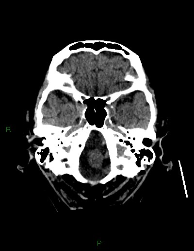 File:Cerebral metastases - ependymal and parenchymal (Radiopaedia 79877-93131 Axial non-contrast 9).jpg