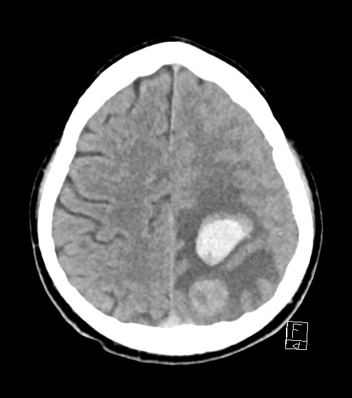 Cerebral metastases - testicular choriocarcinoma (Radiopaedia 84486-99855 Axial non-contrast 17).jpg