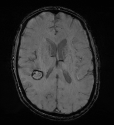 Cerebral metastasis - melanoma (Radiopaedia 54718-60954 Axial SWI 33).png