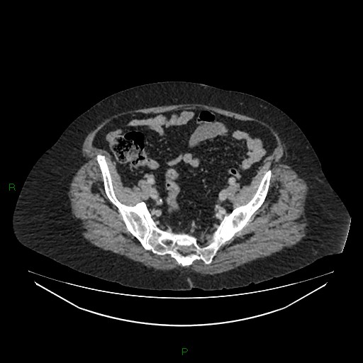 Cerebral metastasis from renal cell carcinoma (Radiopaedia 82306-96378 A 150).jpg