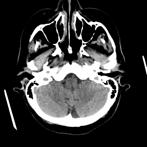 Cerebral metastasis to basal ganglia (Radiopaedia 81568-95412 Axial non-contrast 16).png