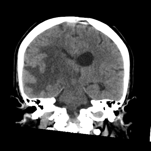 Cerebral metastasis to basal ganglia (Radiopaedia 81568-95412 Coronal non-contrast 40).png
