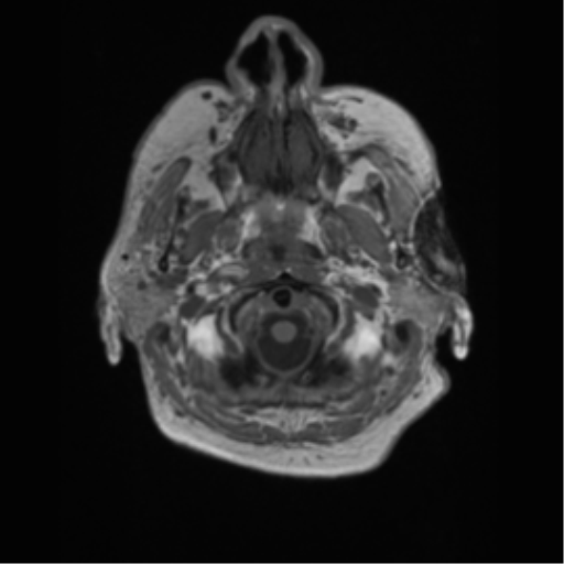 File:Cerebral metastasis to basal ganglia (Radiopaedia 81568-95413 Axial T1 2).png
