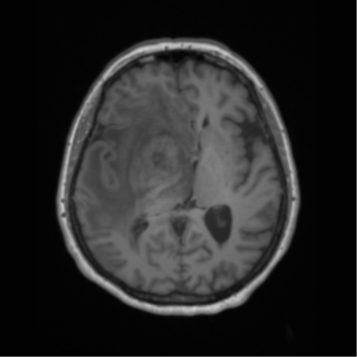File:Cerebral metastasis to basal ganglia (Radiopaedia 81568-95413 Axial T1 36).png