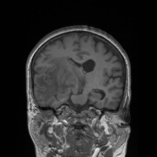 Cerebral metastasis to basal ganglia (Radiopaedia 81568-95413 Coronal T1 26).png