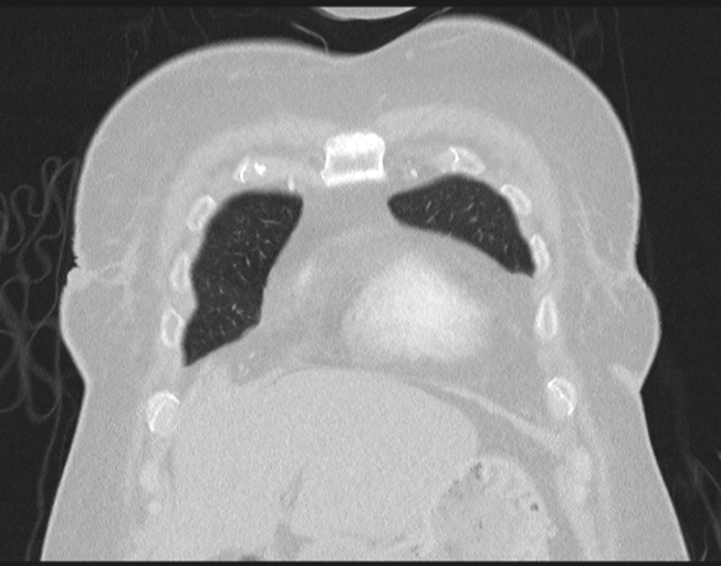File:Cerebral metastasis to basal ganglia (Radiopaedia 81568-95414 Coronal lung window 19).png