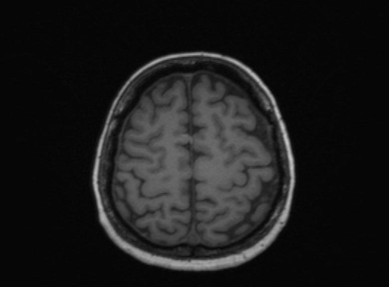 Cerebral ring enhancing lesions - cerebral metastases (Radiopaedia 44922-48817 Axial T1 146).jpg
