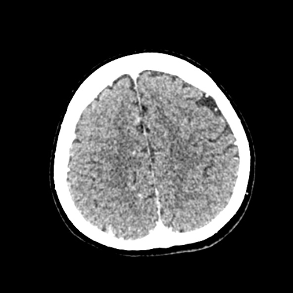 Cerebral ring enhancing lesions - cerebral metastases (Radiopaedia 44922-48818 B 219).jpg