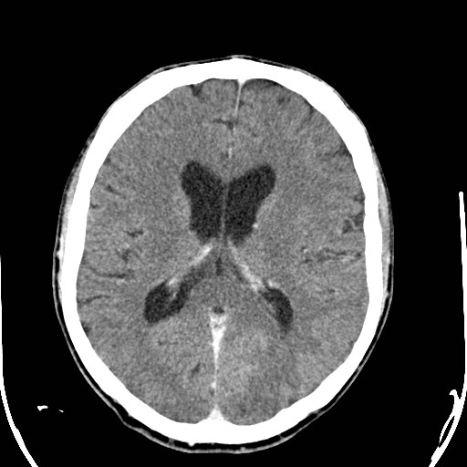 File:Cerebral toxoplasmosis (Radiopaedia 43956-47460 Axial C+ delayed 21).jpg