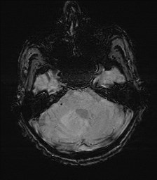 File:Cerebral toxoplasmosis (Radiopaedia 43956-47461 Axial SWI 10).jpg
