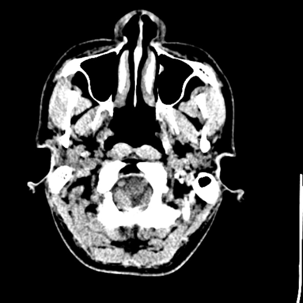File:Cerebral toxoplasmosis (Radiopaedia 53993-60131 Axial non-contrast 8).jpg