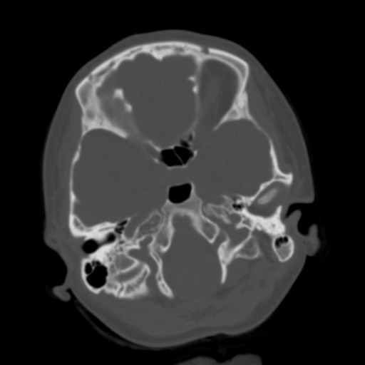 Cerebral tuberculosis with dural sinus invasion (Radiopaedia 60353-68018 Axial bone window 9).jpg