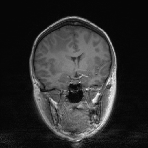 Cerebral tuberculosis with dural sinus invasion (Radiopaedia 60353-68090 Coronal T1 83).jpg