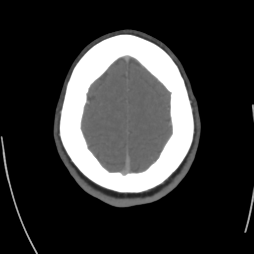 Cerebral venous infarct related to dural venous sinus thromboses (Radiopaedia 35292-36804 Axial C+ delayed 42).png