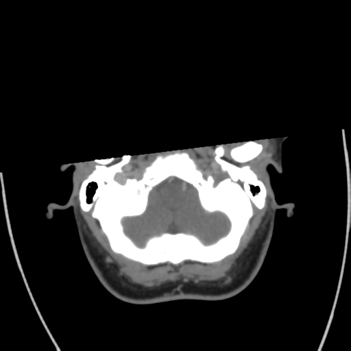 Cerebral venous infarct related to dural venous sinus thromboses (Radiopaedia 35292-36804 Axial C+ delayed 8).png