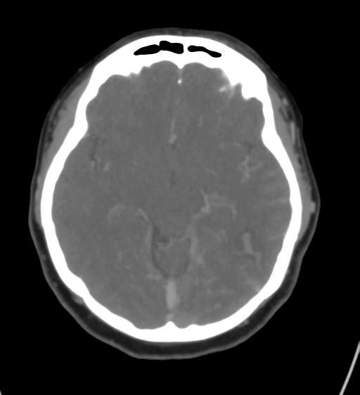 Cerebral venous infarction due to transverse sinus thrombosis (Radiopaedia 34688-36120 Axial CT venogram 23).png